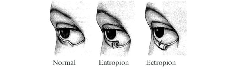 eyelid abnormalities