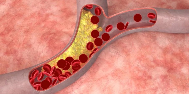 plaques in blood vessels