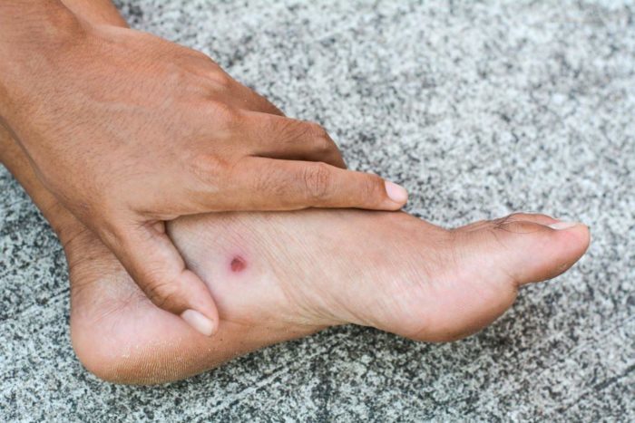 complications of diabetes foot ulcers
