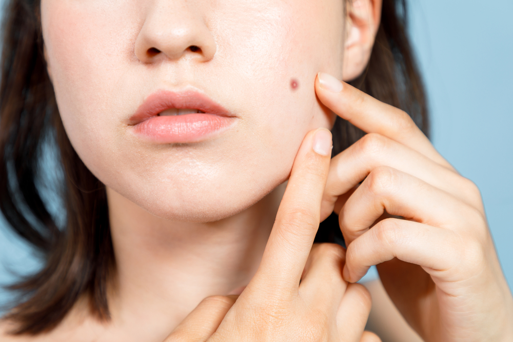 acne on dry skin