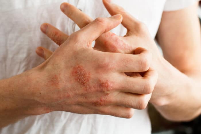 overcome eczema in the hand
