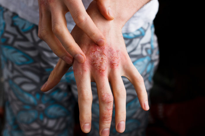 dry eczema and wet eczema