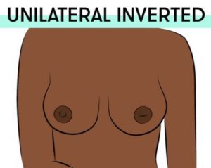 nipple type