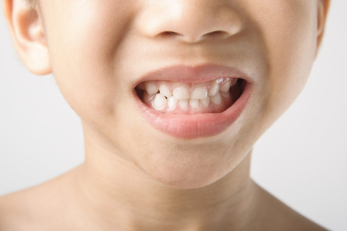 stains on children's teeth