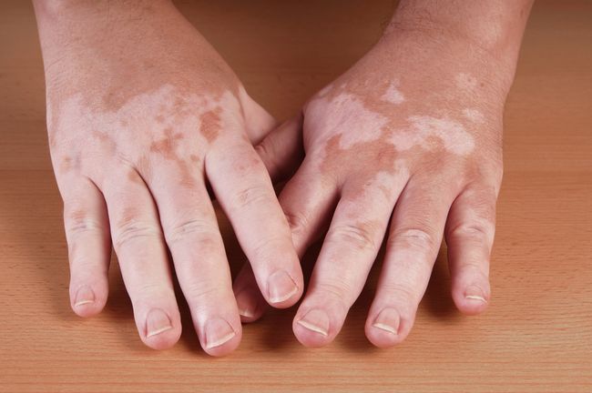 vitiligo can heal