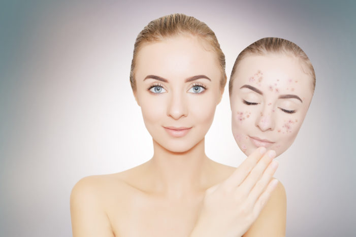 Remove acne scars black spots