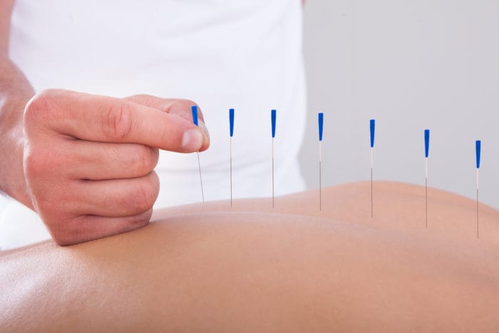 acupuncture relieves pain