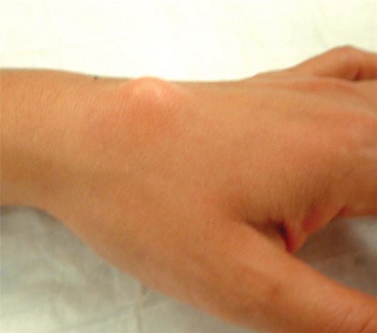 Upper wrist wrist ganglion cyst (source: American Society for Surgery of the Hand)