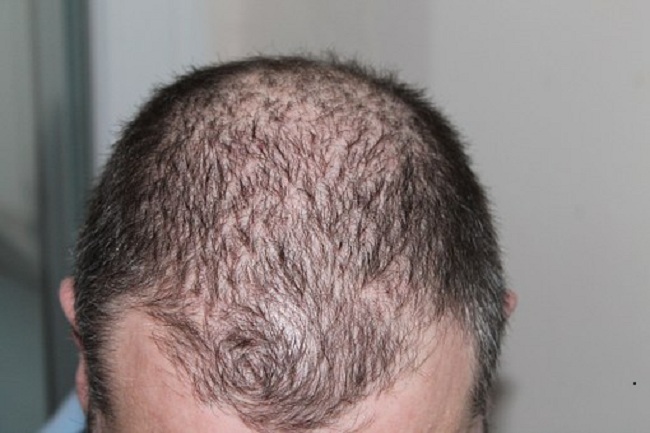 Men's bald hair is infertile