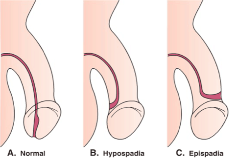 the penis hole is not normal, episodes of hypospadias