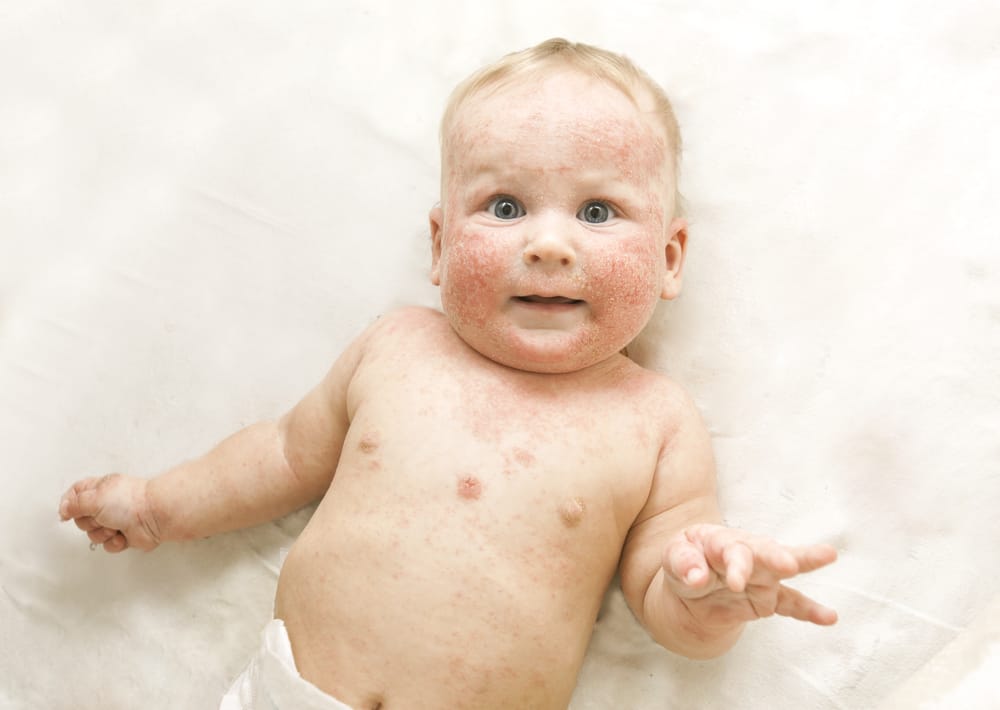 eczema in infants