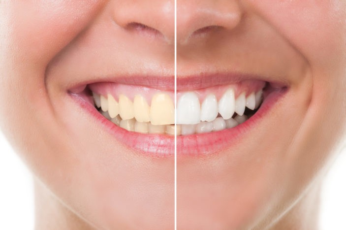 Side effects of whitening teeth with bleaching