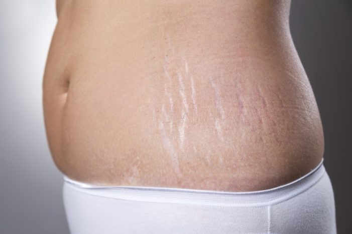 Tips to Prevent Stretch Marks while Pregnant