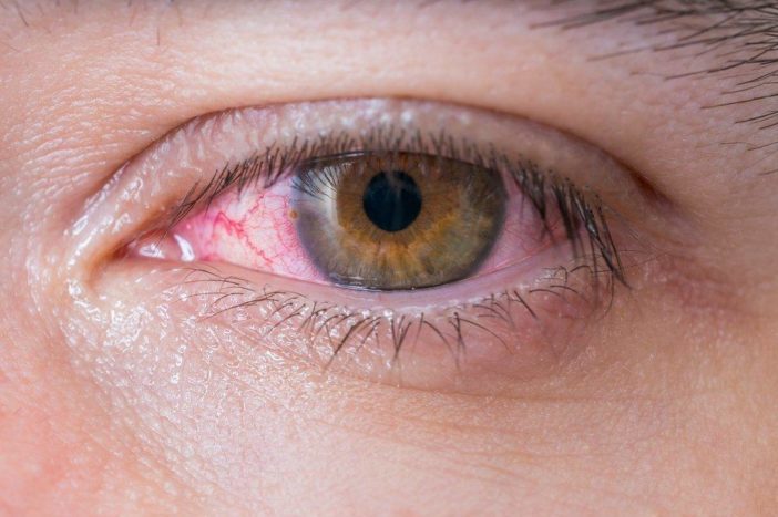 allergic red eye conjunctivitis
