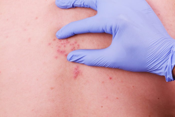 what is shingles? chicken pox or smallpox snake pain