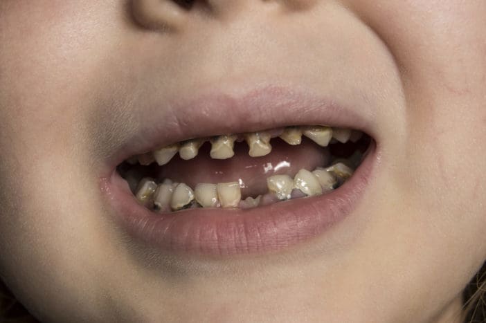baby bottle tooth decay for children's tooth decay