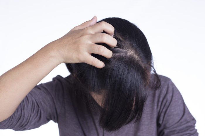 natural ingredients to expel itchy scalp