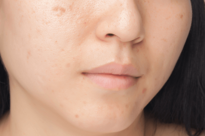 method for removing facial scars