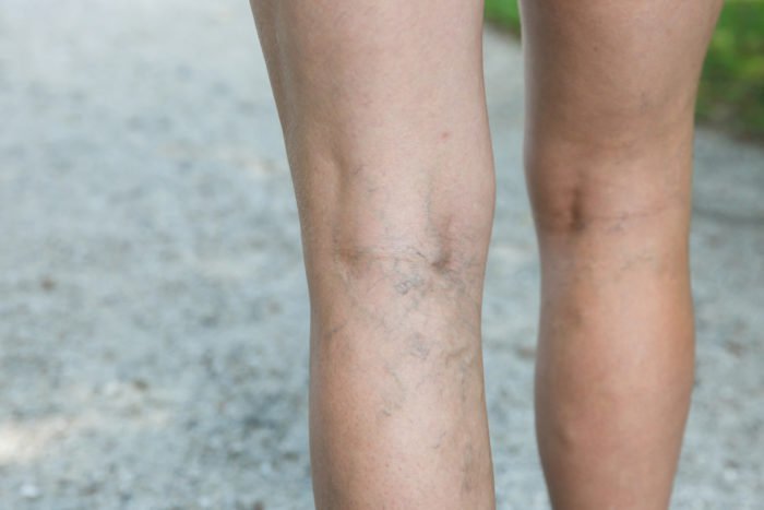 how to get rid of varicose veins