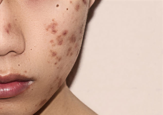 Castor oil castor oil removes acne scars