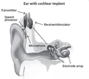 cochlear implant device
