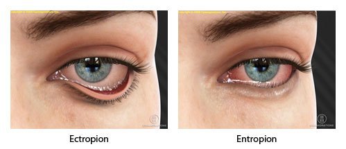 ectropion of eyelid abnormalities