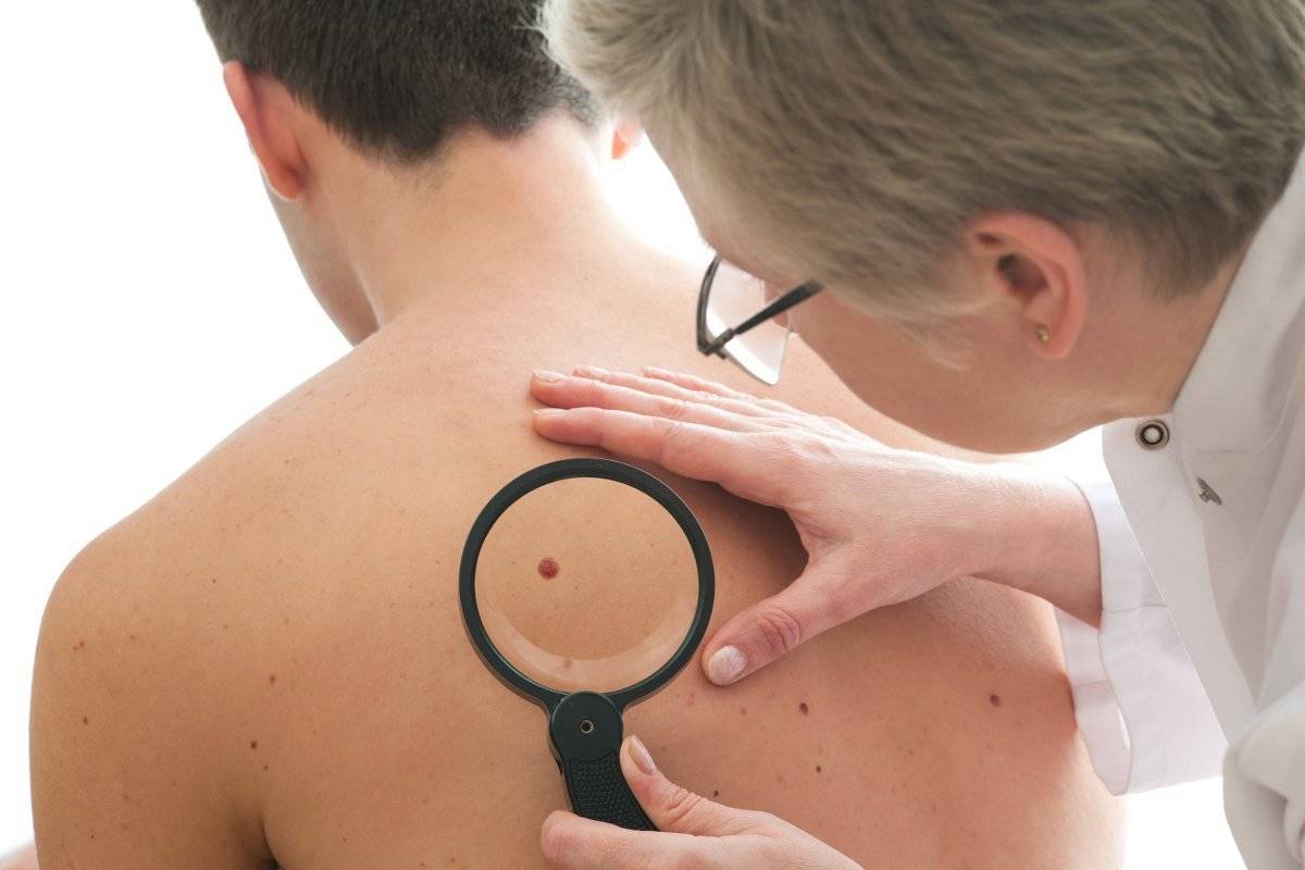 health facts of melanoma moles