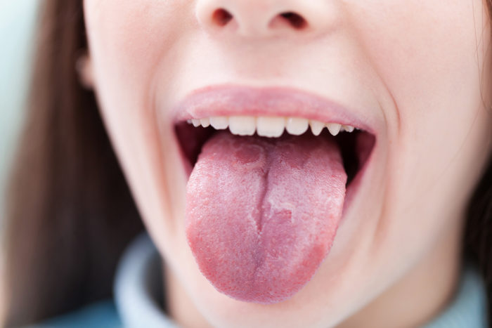 tongue psoriasis