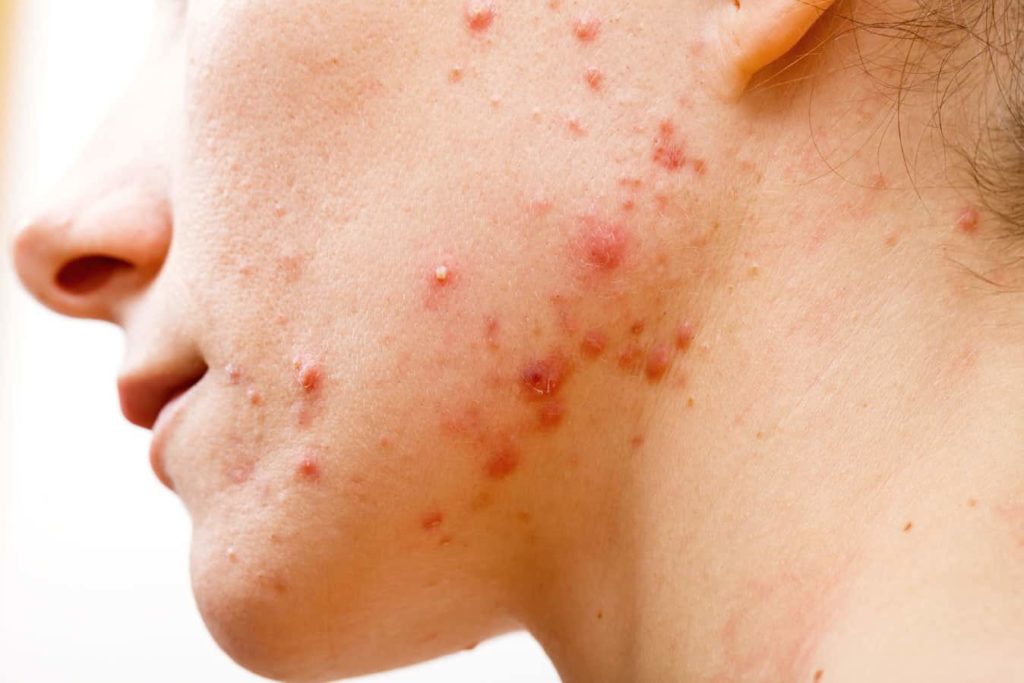 clindamycin inflamed acne medication