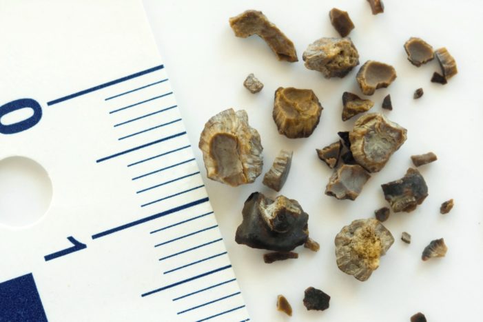 kidney stones and gallstones