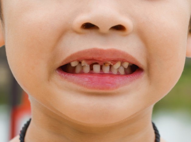 damage to children's teeth