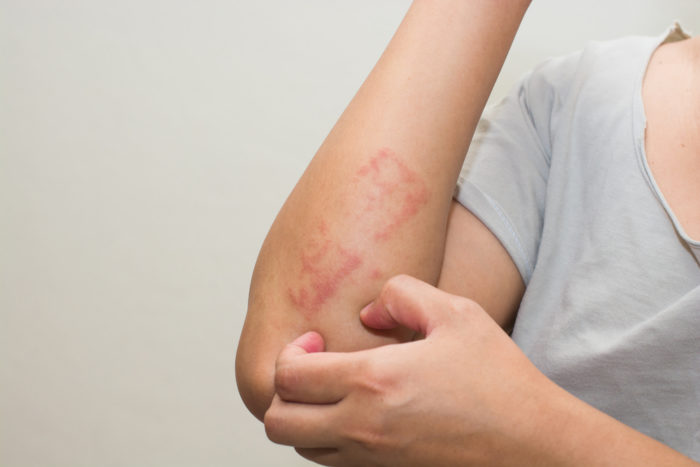overcoming eczema