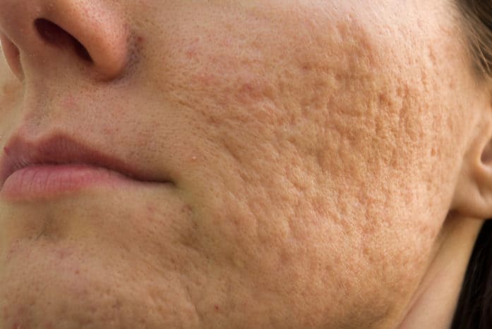 how to get rid of pockmark acne scars