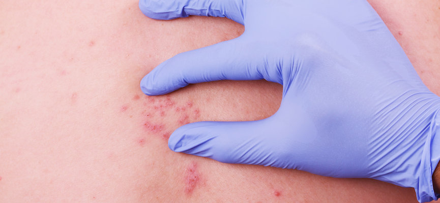 prevent contracting scabies