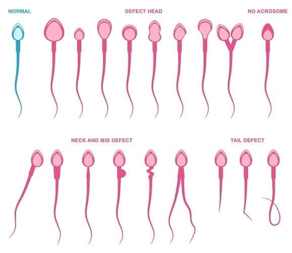 sperm abnormalities