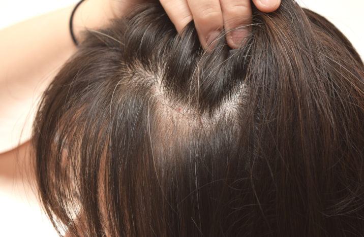 prevent gray hair at a young age
